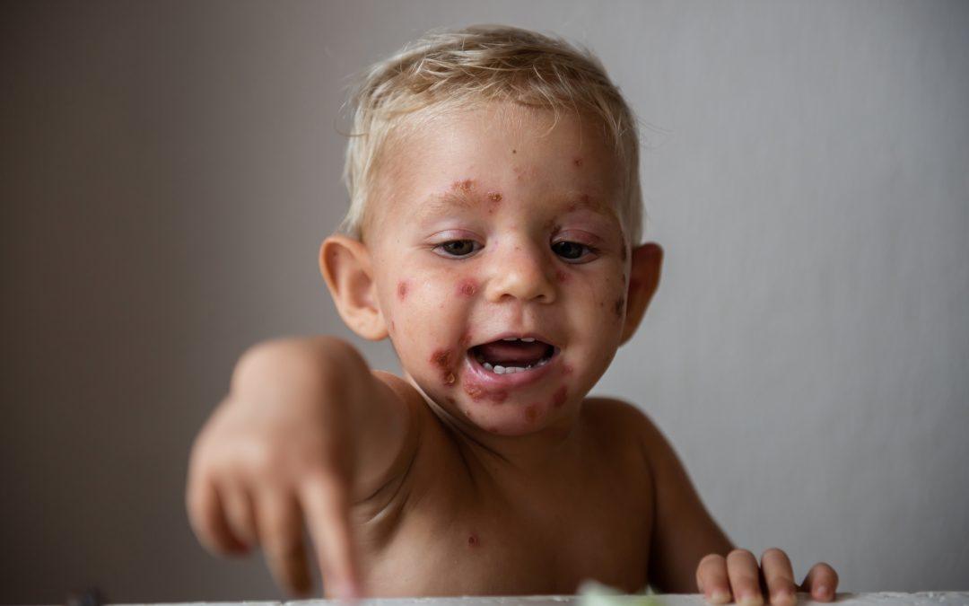 Cerebelitis: ko norice niso več nedolžne