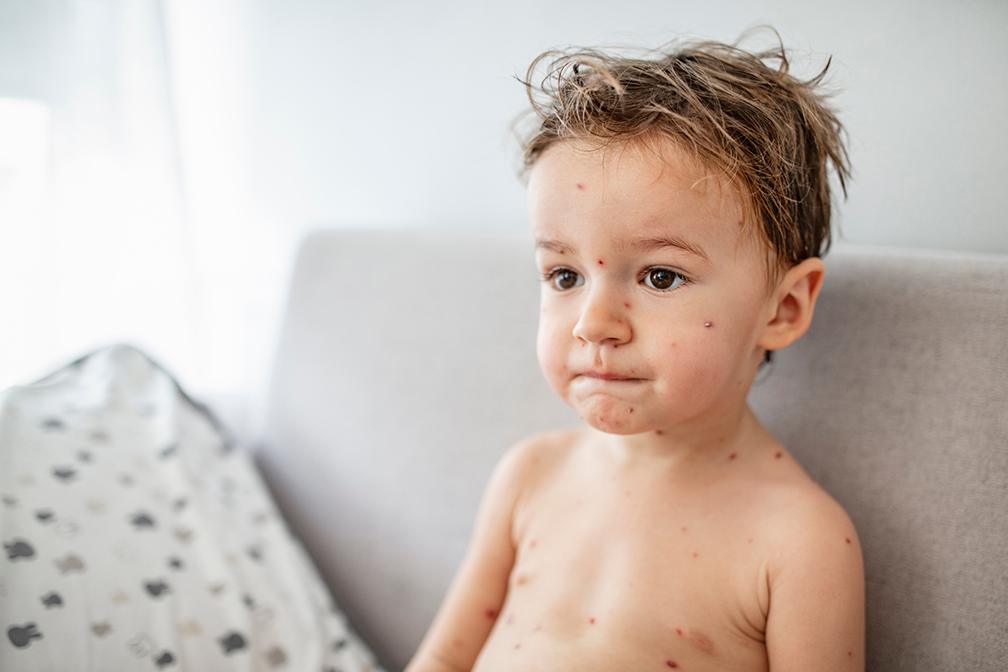 Norice poleti: Mi planiramo morje, otrok ima pa norice. Nočna mora.